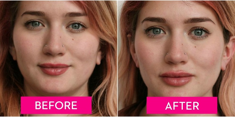The Difference Between Lip Filler & Lip Augmentation